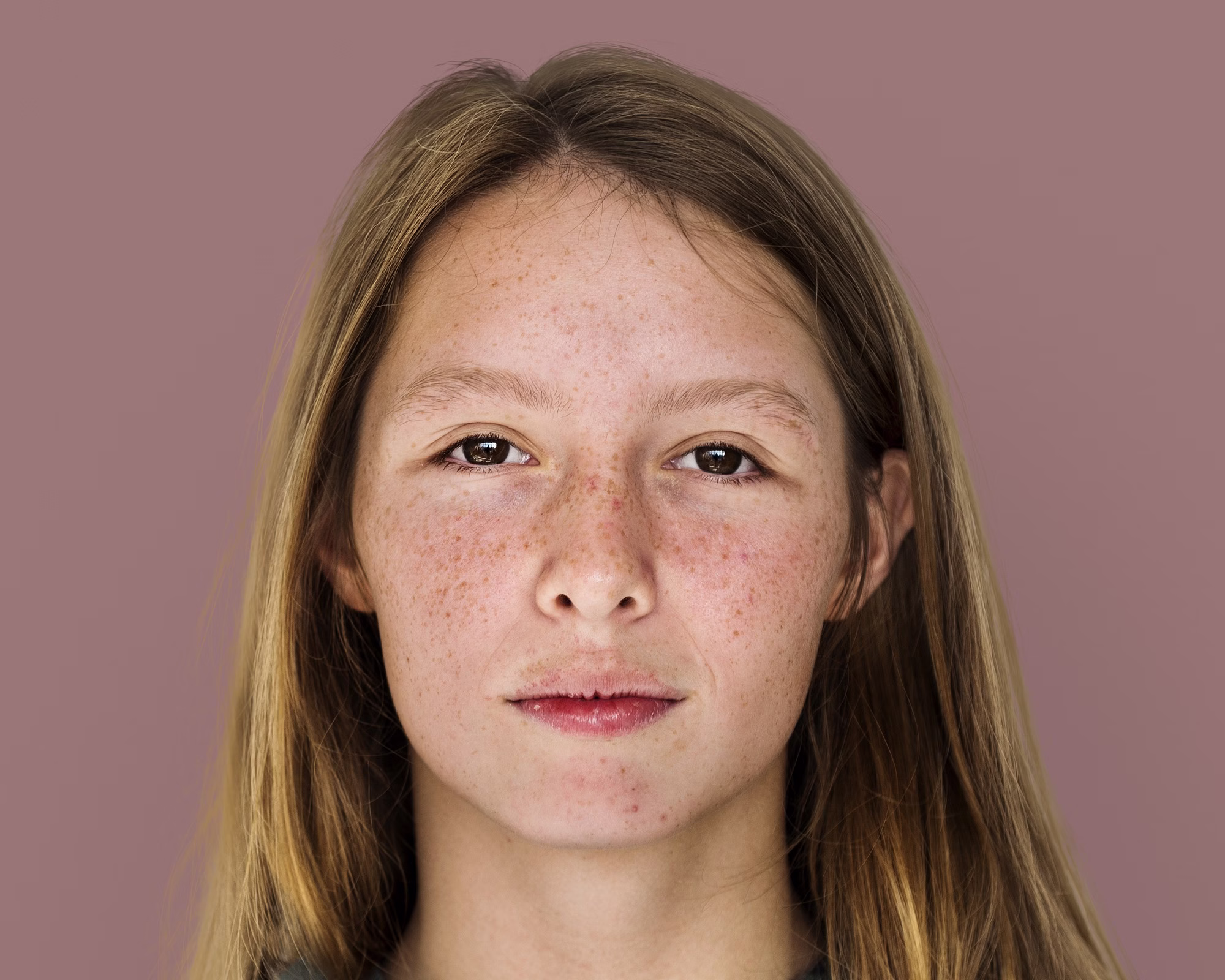 Treatment of facial hyperpigmentation and melasma