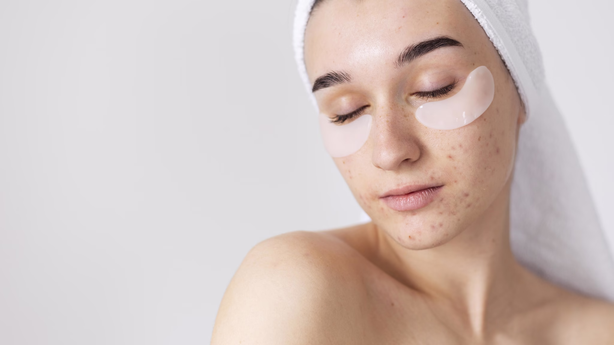 Acne scar treatment with modern methods